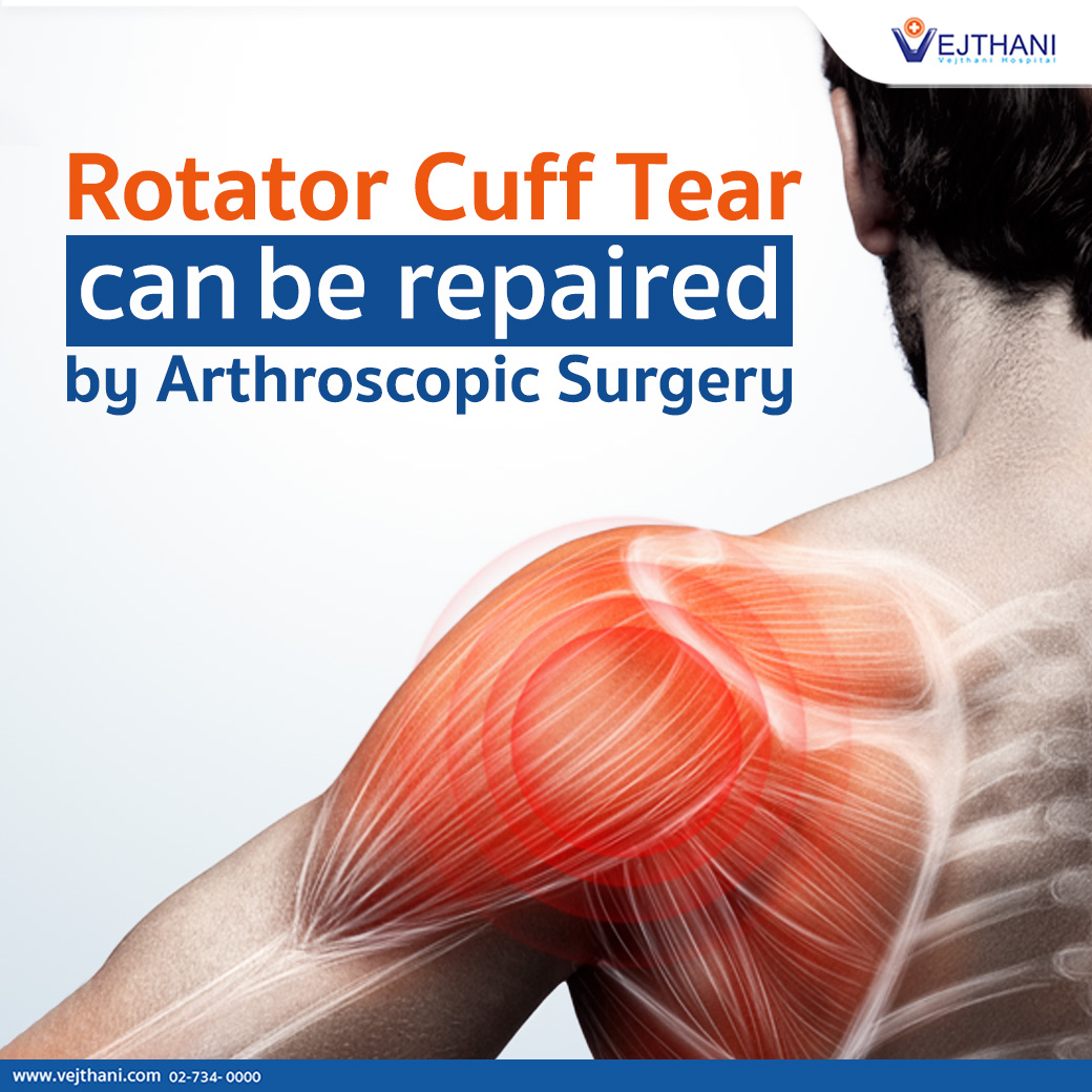 Rotator Cuff Tear