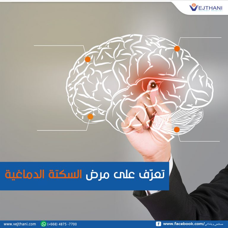 السكتة الدماغية