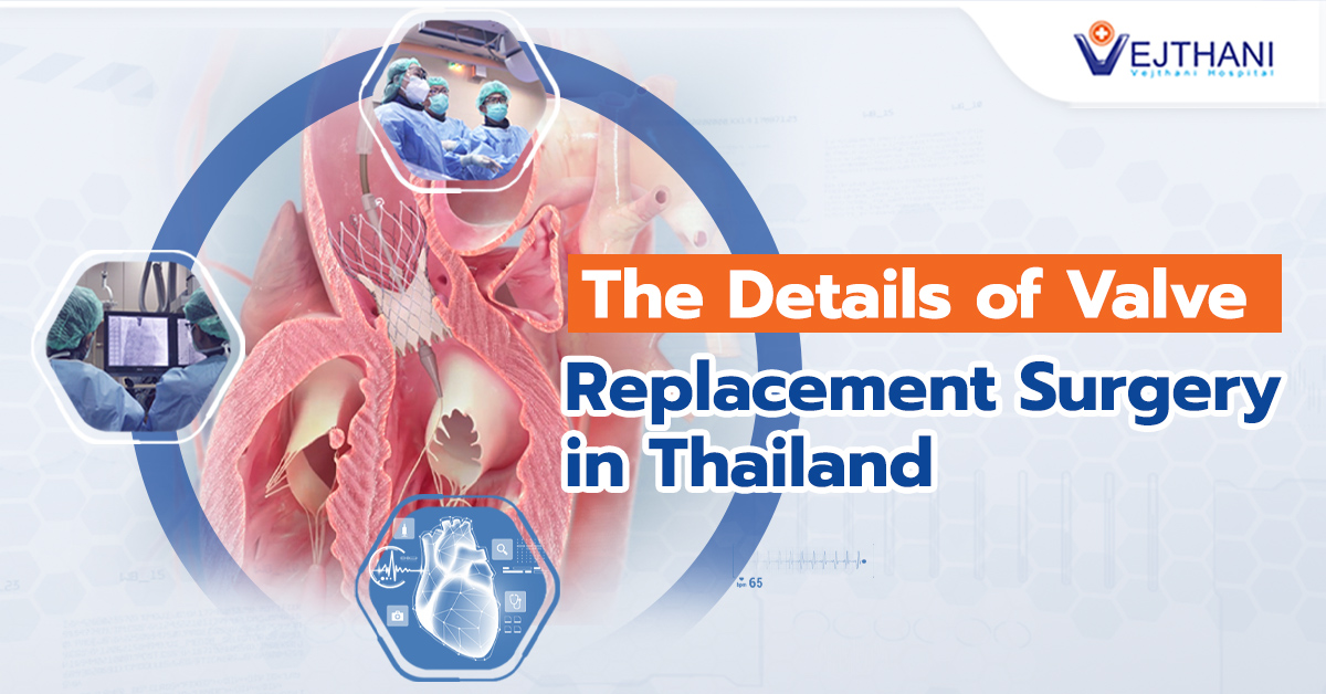 በታይላንድ ውስጥ የልብ ቧንቧ (ቫልቭ) ምትክ ቀዶ ጥገና ዳሰሳ