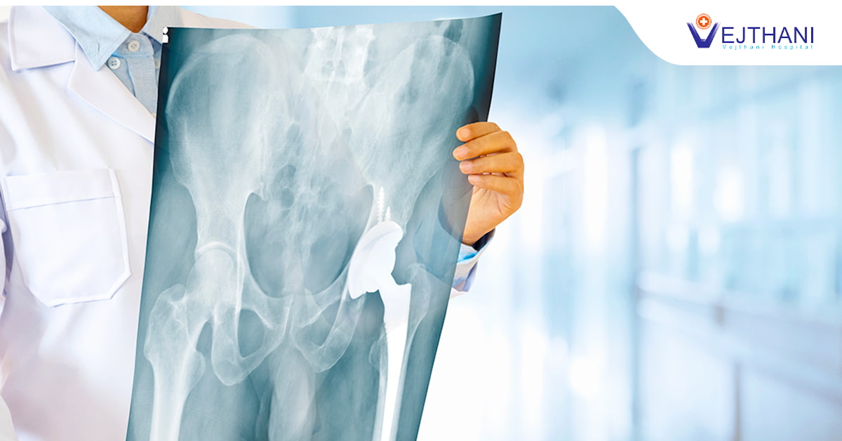 থাইল্যান্ডে সম্পূর্ণ হিপ প্রতিস্থাপন সার্জারির একটি ওভারভিউ