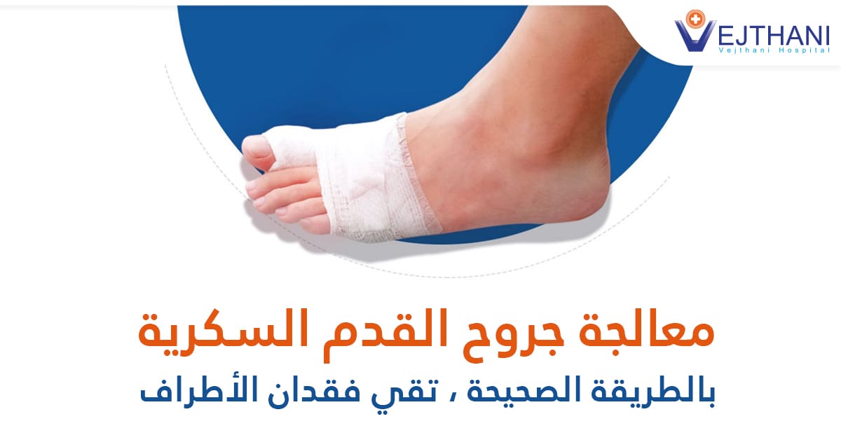 معالجة جروح القدم السكرية بالطريقة الصحيحة، تقي فقدان الأطراف