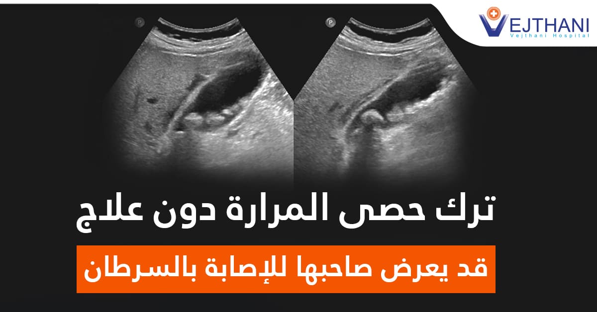 ترك حصى المرارة دون علاج، قد یعرض صاحبھا للإصابة بالسرطان