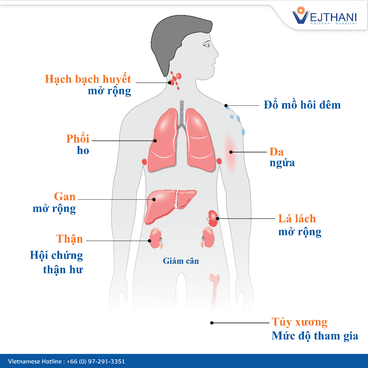 Bệnh viện Vejthani cung cấp dịch vụ điều trị ung thư hạch ở Thái Lan