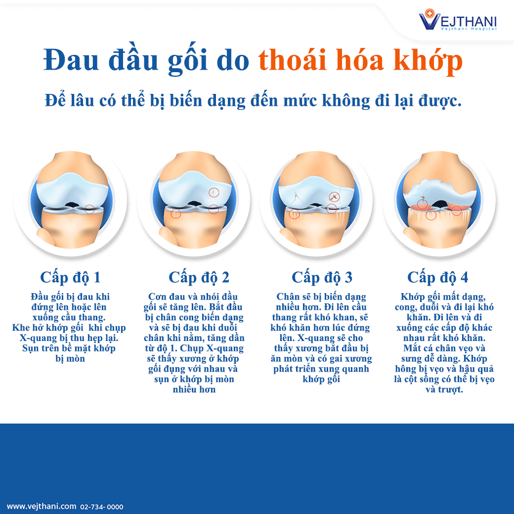 Thoái hóa khớp gối là căn bệnh không thể tránh khỏi nhưng có thể chậm quá trình.
