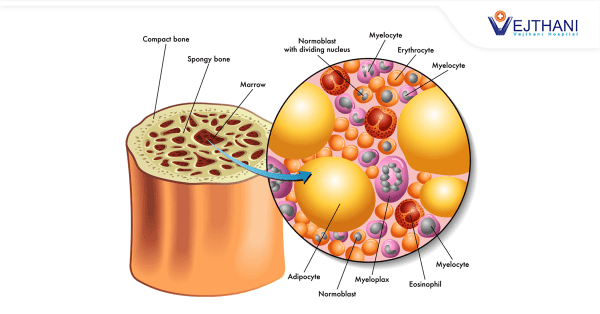 How Bone Marrow Transplant (Stem Cell) is used to Treat Cancer